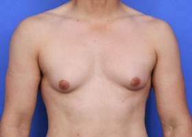 Patient Before & After Image