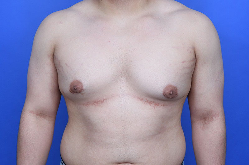 Gynecomastia Surgery Before & After Image