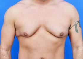 Revision Gynecomastia Surgery Before & After Image