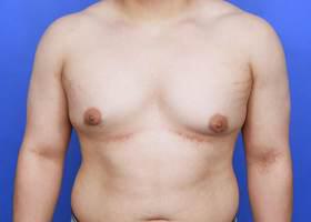 Revision Gynecomastia Surgery Before & After Image