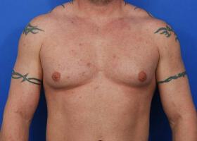 Revision Gynecomastia Surgery Before & After Image