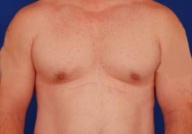 Revision Gynecomastia Surgery Before & After Image
