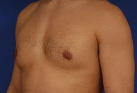 Revision Gynecomastia Surgery Before & After Image