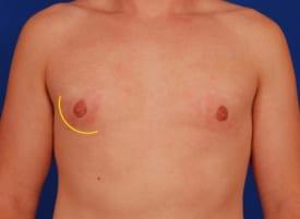 Revision Gynecomastia Surgery Before & After Image