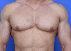 Austin Gynecomastia Surgery patient Before