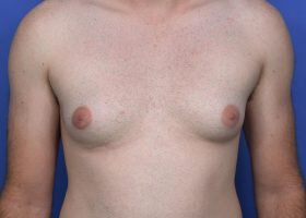 Austin Gynecomastia Surgery patient Before