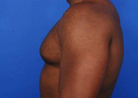 Austin Gynecomastia Surgery patient Before