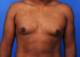 Austin Gynecomastia Surgery patient Before