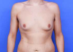 Austin Gynecomastia Surgery patient Before