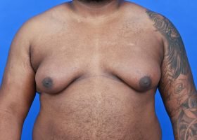 Austin Gynecomastia Surgery patient Before