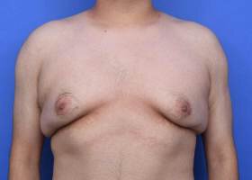 Austin Gynecomastia Surgery patient Before