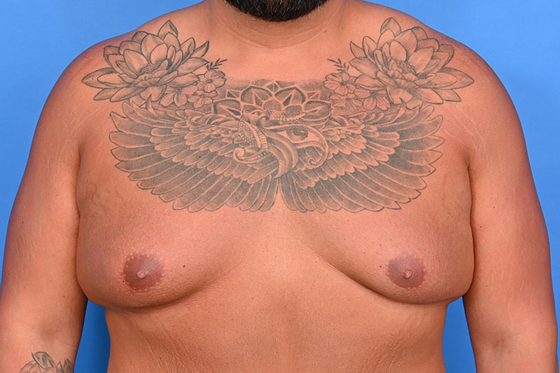 Gynecomastia Surgery Before & After Image