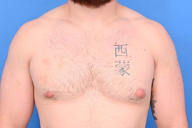Gynecomastia Surgery Before & After Image