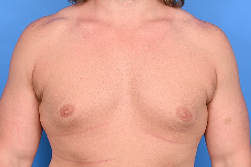 Gynecomastia Surgery Before & After Image
