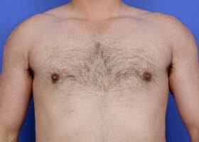 Patient Before & After Image