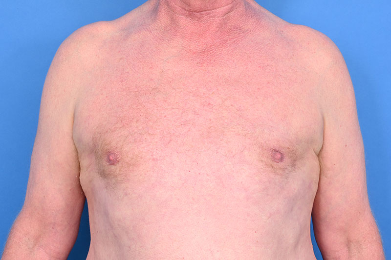 Patient Before & After Image