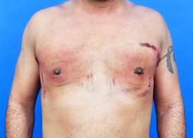 Revision Gynecomastia Surgery Before & After Image