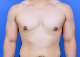 Revision Gynecomastia Surgery Before & After Image