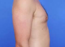 Revision Gynecomastia Surgery Before & After Image