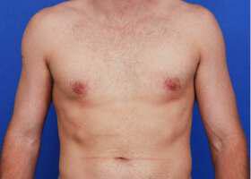 Revision Gynecomastia Surgery Before & After Image