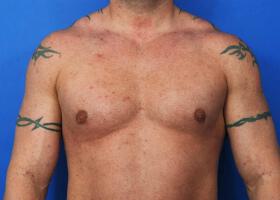 Revision Gynecomastia Surgery Before & After Image