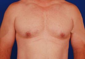 Revision Gynecomastia Surgery Before & After Image