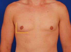 Revision Gynecomastia Surgery Before & After Image
