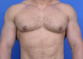 Austin Gynecomastia Surgery patient After