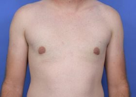 Austin Gynecomastia Surgery patient After