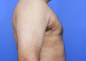 Austin Gynecomastia Surgery patient After