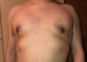 Austin Gynecomastia Surgery patient After