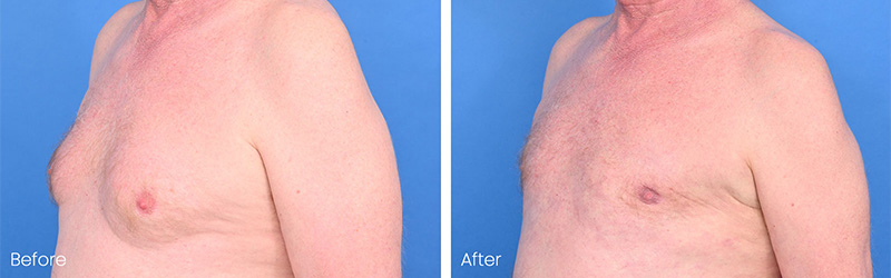 Advanced gynecomastia patient during evaluation at Austin Gynecomastia Center