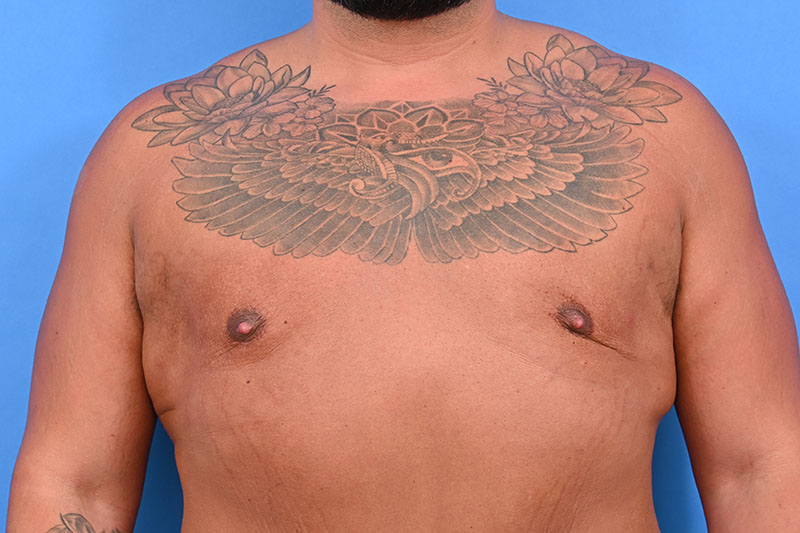 Gynecomastia Surgery Before & After Image