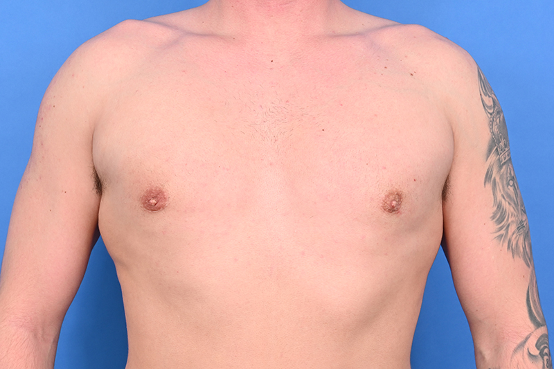 Patient Before & After Image