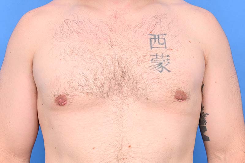 Gynecomastia Surgery Before & After Image