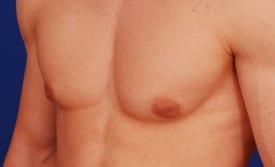 Revision Gynecomastia Surgery Before & After Image
