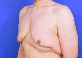 Gynecomastia Surgery Before & After Image