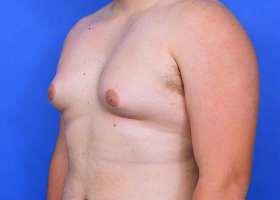 Gynecomastia Surgery Before & After Image