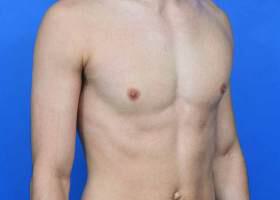 Gynecomastia Surgery Before & After Image