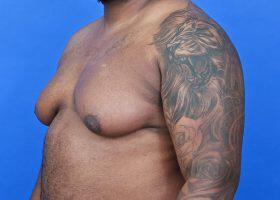Gynecomastia Surgery Before & After Image