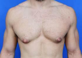 Gynecomastia Surgery Before & After Image