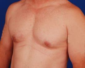 Revision Gynecomastia Surgery Before & After Image