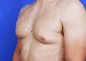 Gynecomastia Surgery Before & After Image