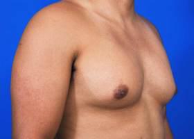 Gynecomastia Surgery Before & After Image