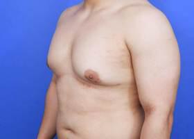 Gynecomastia Surgery Before & After Image