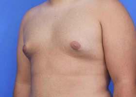 Gynecomastia Surgery Before & After Image