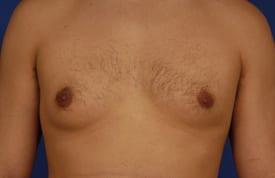 Revision Gynecomastia Surgery Before & After Image