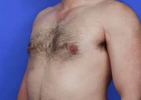 Gynecomastia Surgery Before & After Image