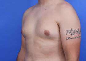 Gynecomastia Surgery Before & After Image
