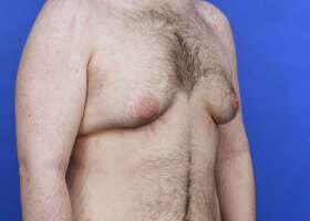 Gynecomastia Surgery Before & After Image